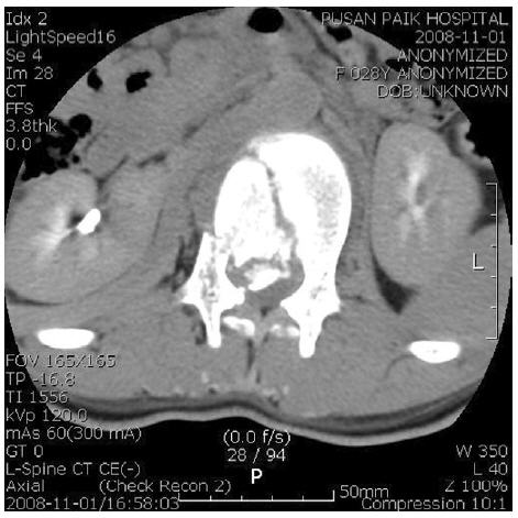 2008.11.1 L-spine CT