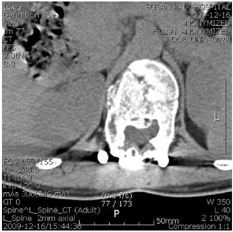2009.12.16 L-spine CT