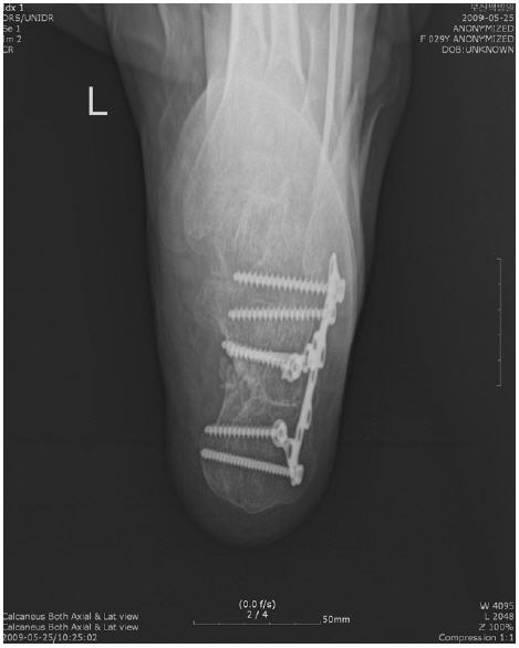 2009년 5월 Calcaneous X-ray
