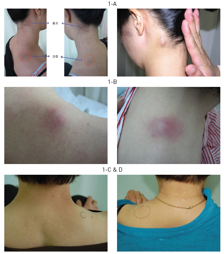 The aspects of inflammatory response caused that prolonged usage of pharmacopuncture lubricant on the specificpoint (GB20, GB21). The patient of D was operated inflammatory region.