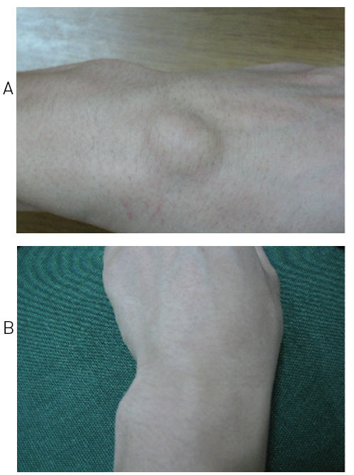 Change of Wrist Ganglion. A: First treatment,B:Third treatment