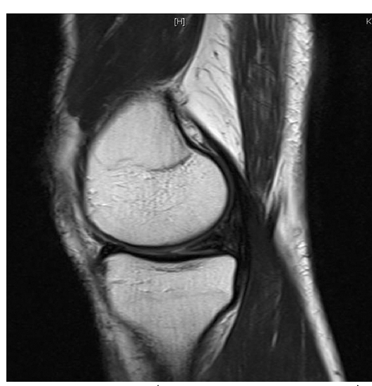 MRI of Lt. Knee (Case 1, T1 weight sagittal view)
