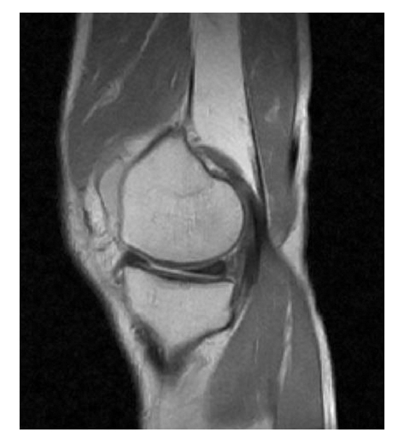 MRI of Rt. Knee (Case 3, T1 weight sagittal view)