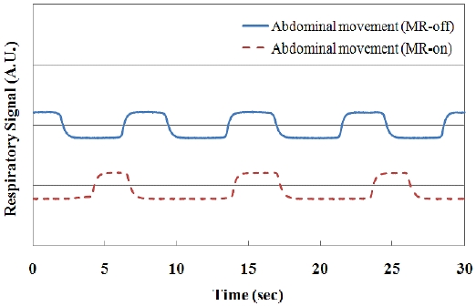 Output voltage variation of an abdomen-attached fiber-optic respiration sensor due to the abdominal movement.