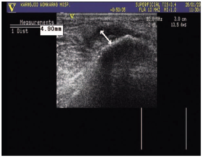 A transverse image of extensor carpi radialis brevistendon of 58yrs old women with lateral epicondylitis(Lt.) is shown. The tendon of lession is measured4.90mm.