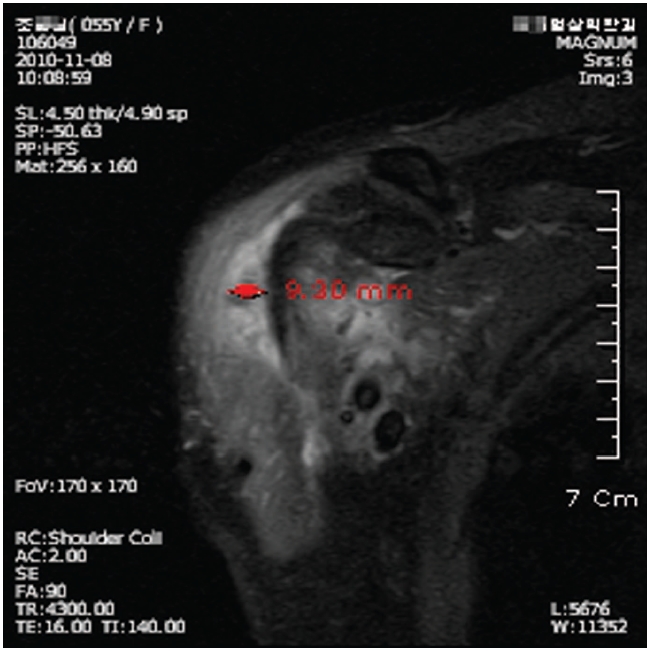 MRI of acute subdeltoid bursitis of the right shoulderdepth of subdeltoid bursitis was measured in about9.30mm