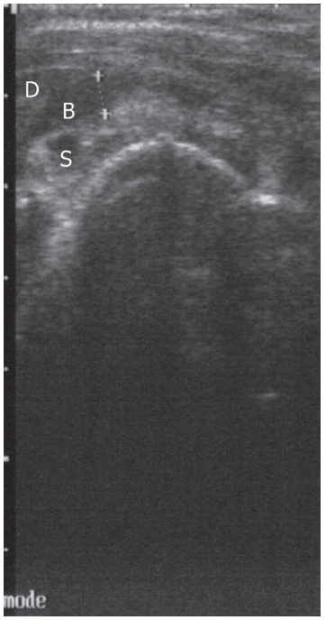 Ultrasonographic finding of acute subdeltoid bursitisdepth of subdeltoid bursitis was measured in about4.12mm. (B: subdeltoid bursa D: deltoid muscle S:supraspinatus muscle)