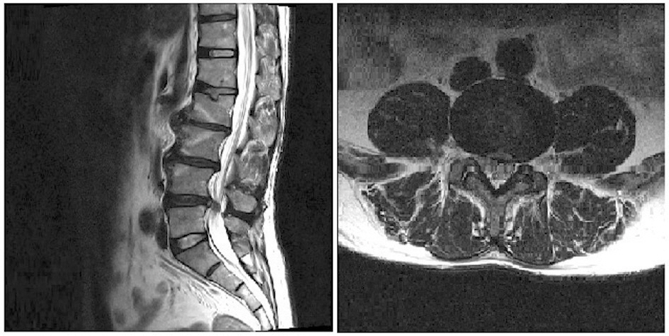 Magnetic resonance imaging of the lumbar spine was obtained in April 2010. Sagital left T2 weighted image showing a large posterior and inferior extruded. Axial Right T2 weighted image showing a extruded disc in the right paracentral zone at the L4-5.