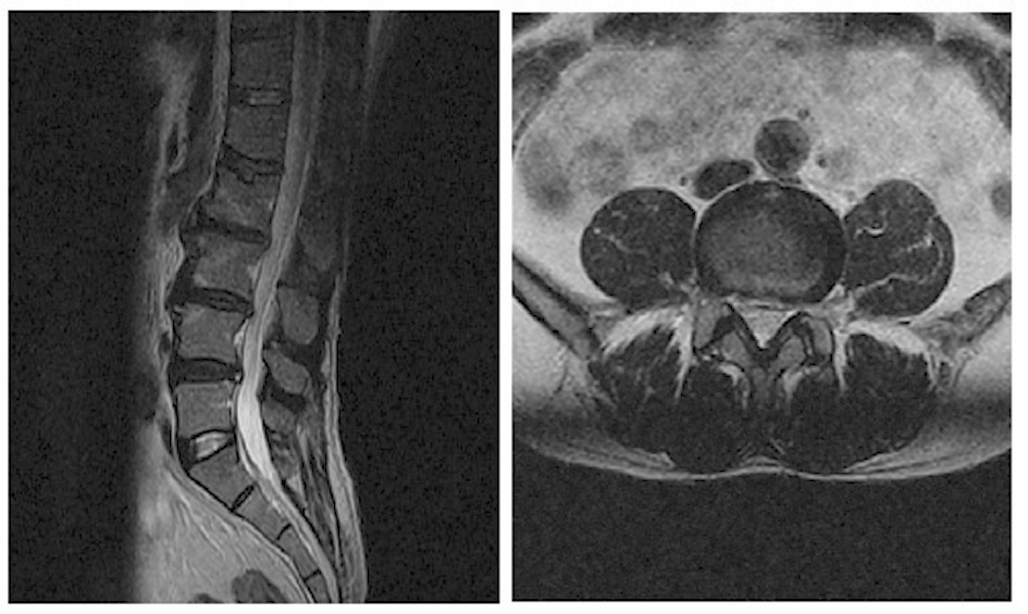 Magnetic resonance imaging of the lumbar spine was obtained in March 2011. Sagital left T2 weighted image showing bulging type disc. Axial Right T2 weighted image showing Improvement of HNP at the L4-5.