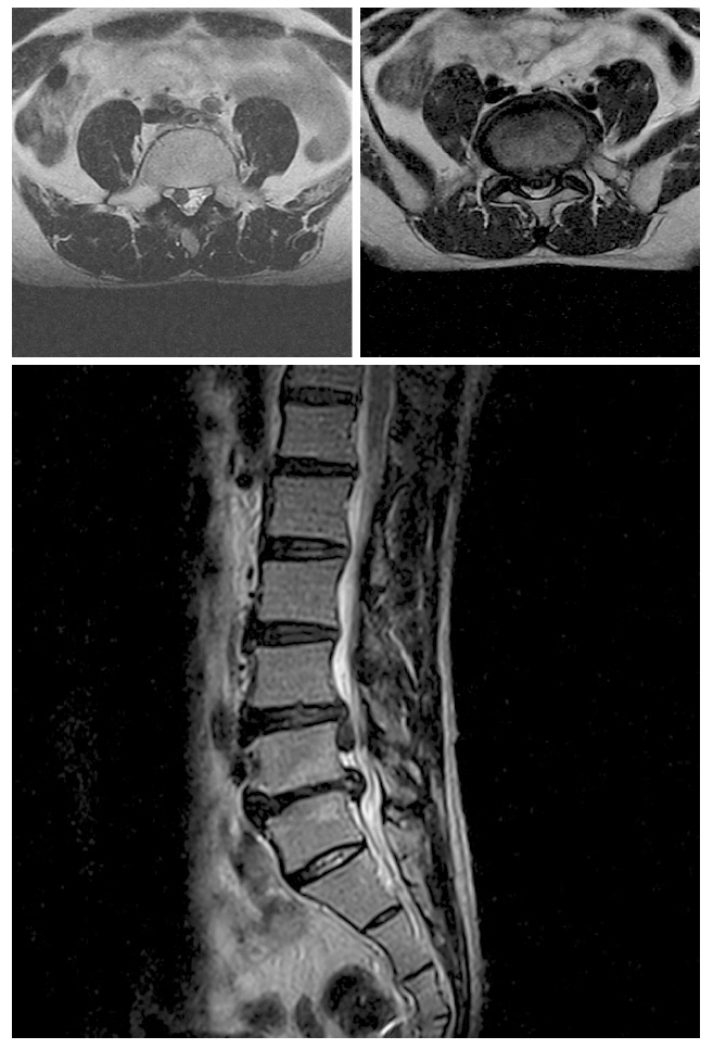 Magnetic resonance imaging of the lumbar spine was obtained in January 2008. Sagital lower left T2 weighted image showing a large posterior and inferior sequestered. Axial upper left T2 weighted image showing oval shaped hypointensity mass in right anterior portion of spinal canal of L3-4. Axial upper right T2 weighted image showing a extruded disc in the central zone at the L4-5.