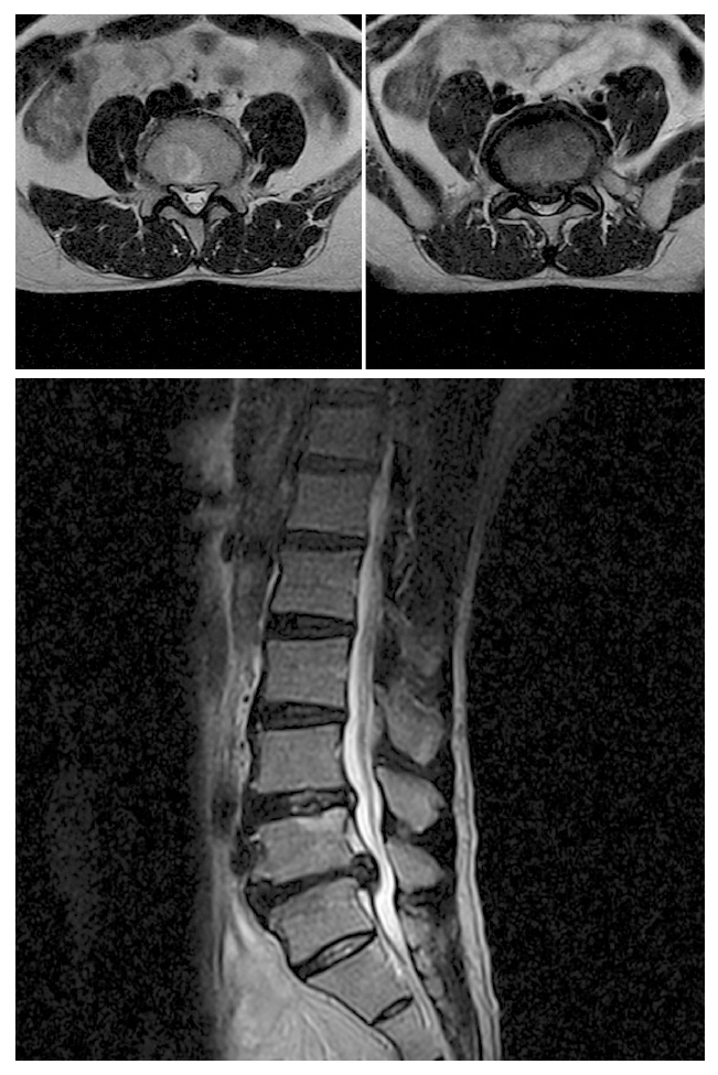 Magnetic resonance imaging of the lumbar spine was obtained in May 2011. Sagital lower left T2 weighted image showing bulging and extruded type disc. Axial upper left T2 weighted image showing a bulging type disc of L3-4. Axial upper right T2 weighted image showing a extruded disc in the central zone at the L4-5.