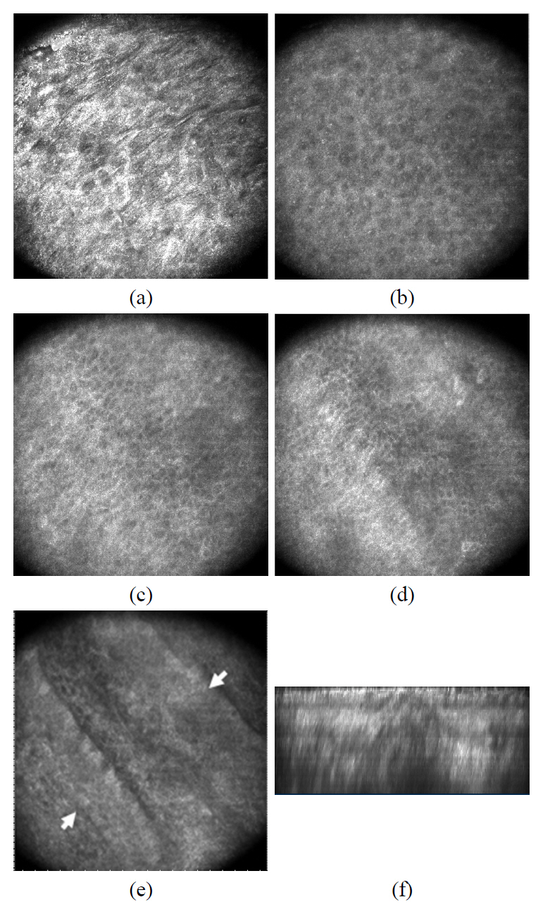 En face image of ex vivo human skin observed with confocal. (a) Skin surface (b) 10 μm belowthe surface (c) 20 μm below the surface (d) 30 μm belowthe surface (e) 40 μmbelow the surface (f) B-scan image of the human skin