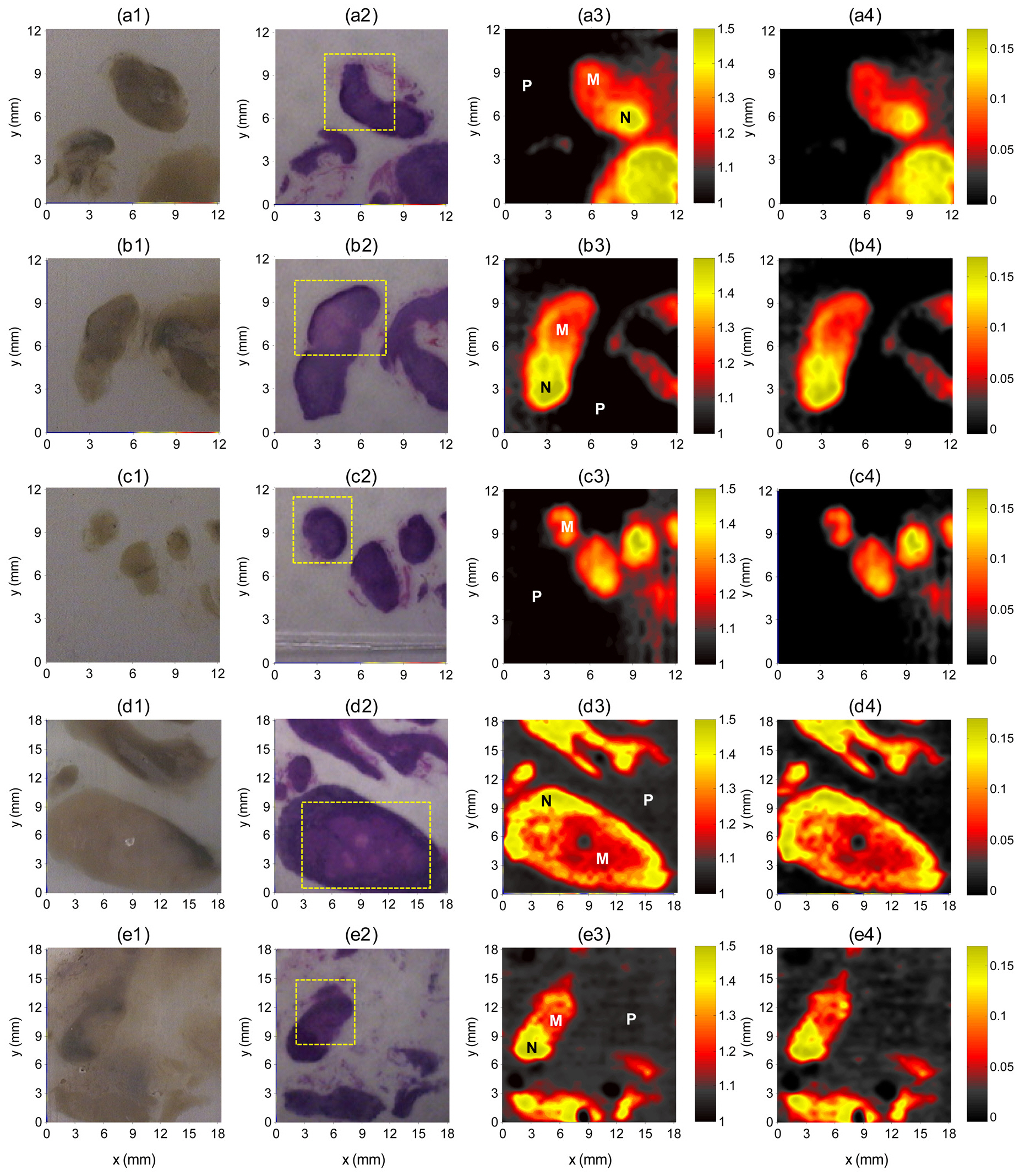 Optical (column 1), histopathologic (column 2), and THz images (columns 3 and 4) of five paraffin-embedded metastaticlymph nodes from two patients. The THz images were obtained using E(x, y)/E0 (column 3) and Δn(x, y, f)/np (column 4). Selectedpixels are indicated in column 3 (P: paraffin, M: metastatic portion, N: non-metastatic portion). The dashed boxes indicate themetastatic portion identified by histopathologic examination. The THz images showed good correlations with histopathologic results.