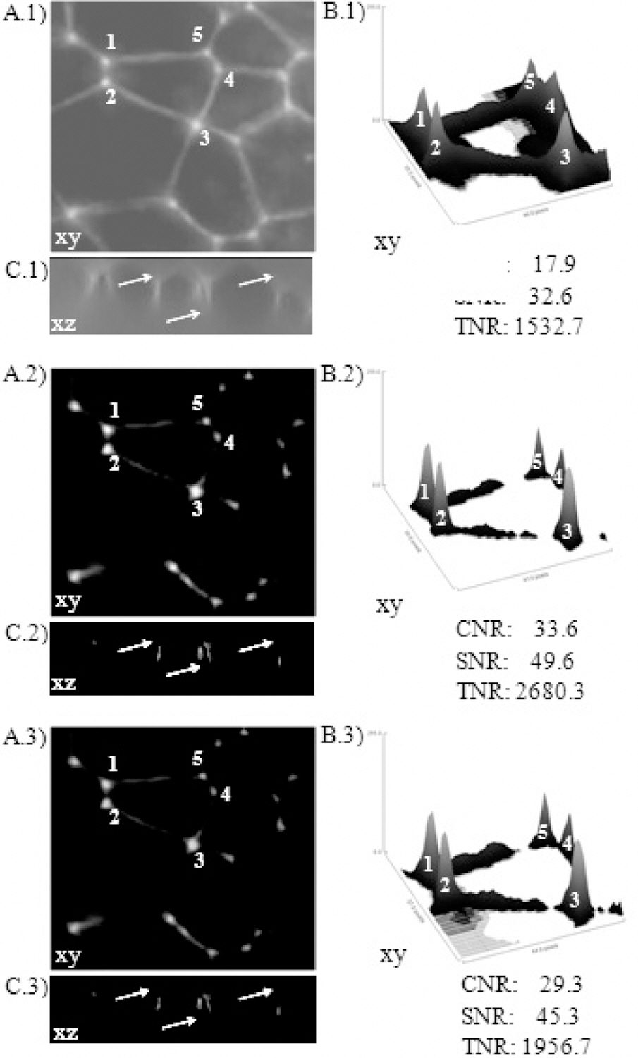 Deconvolution of a Rhinella arenarum embryo imagesobtained with the 40X objective (128 images at 0.25 μm/step)where each bright dot represents cell-cell contacts. Row 1represents raw images row 2 is row 1 after deconvolution usingan ideal PSF and row 3 is row 1 after deconvolution with anon-ideal PSF (cover slip N° 0). Set A shows 3D maximumintensityprojections set B the surface plot of five pointsindicated in set A and set C one axial cross-section (x-z plane).Numbers (1-5) and arrows are added to mark specific parts ofthe images in order to point out deconvolution improvementsin image quality. CNR (Contrast-to-Noise Ratio) SNR (Signalto-Noise Ratio) and TEN (a Tenengrad-based function) wereused to evaluated image quality. Each indicator represents themean of five stacks.