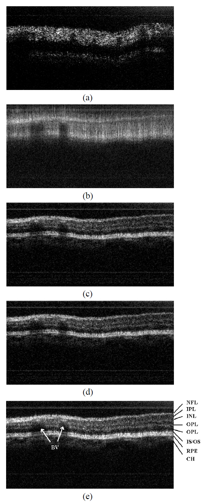 Retinal images of a healthy volunteer. (a) OCT imagewith resampling and without dispersion compensation (b)OCT image without resampling and with dispersion compensation(c) OCT image with resampling and dispersioncompensation using only forward wavelength-swept (d)OCT image with resampling and dispersion compensationusing only backward wavelength-swept (e) OCT image withresampling and dispersion compensation using both wavelength-swept; NFL: nerve fiber layer IPL: inner plexiformlayer INL: inner nuclear layer OPL: outer plexiform layerONL: outer nuclear layer IS/OS: photoreceptor innersegment/outer segment junction RPE: retinal pigmentepithelium CH: choroid BV: blood vessel.