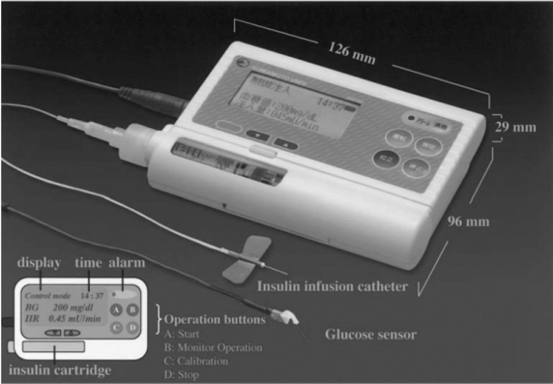A wearable artificial endocrine pancreas with a needle-typeglucose sensor [28].