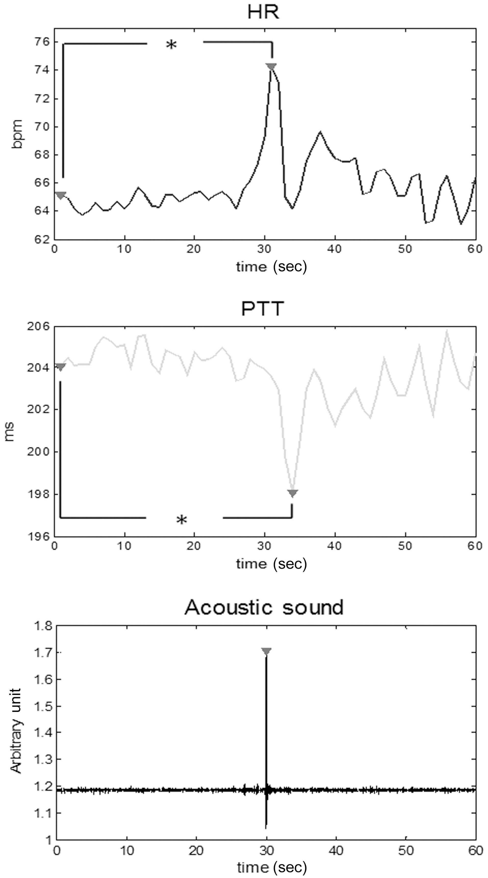 Averaged response of heart rate (HR) pulse transit time (PTT)and acoustic sound for a single swallow in 35 datasets (*P < 0.001).