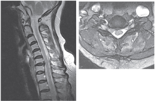 Radiological findings of a 59-year-old female patient who had a C6-7 disc herniation. T2-weighed imaging shows compression of the nerve root at C6-7.