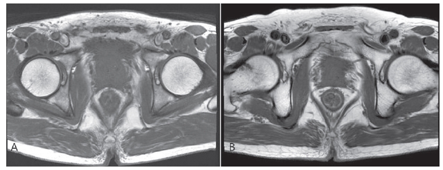 Prostate MRI of Case 1: A. Extensive prostate cancer with extracapsular extension and seminal vesicle invasion. B. No demonstrable recurrent cancer in the prostate and no evidence of lympadenopathy or bony metastasis.