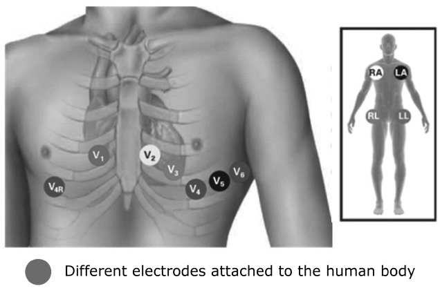Placement of 12-lead electrocardiograams with 10 electrodes. 4 wires are attached to each of the limbs and six wires are placed around the chest.