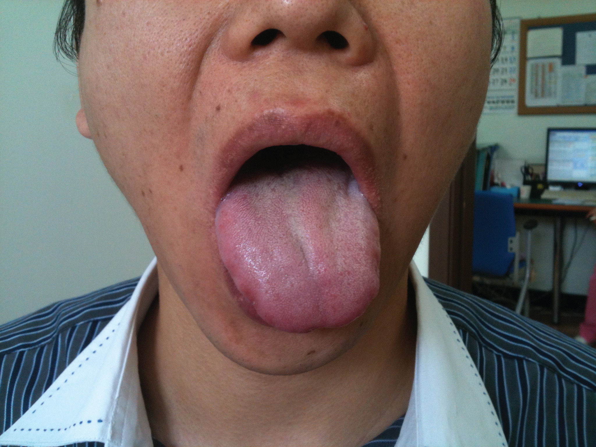 The tongue's deviation on protrusion on the first day of
					treatment. The left-sided deviation of the tongue was not
					improved on the first day of treatment.