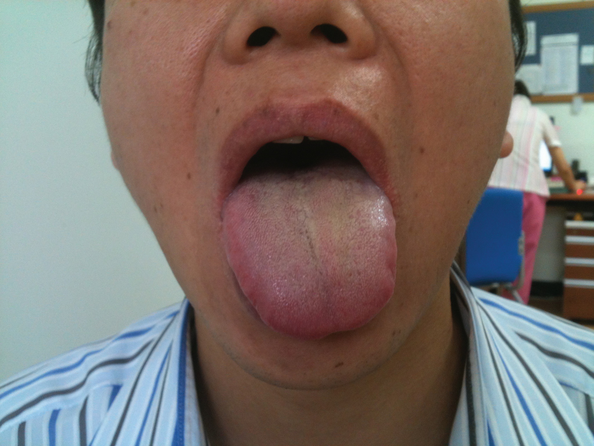 The tongue's deviation on protrusion on the third day of
					treatment. The left-sided deviation of the tongue was
					slightly improved on the third day of treatment