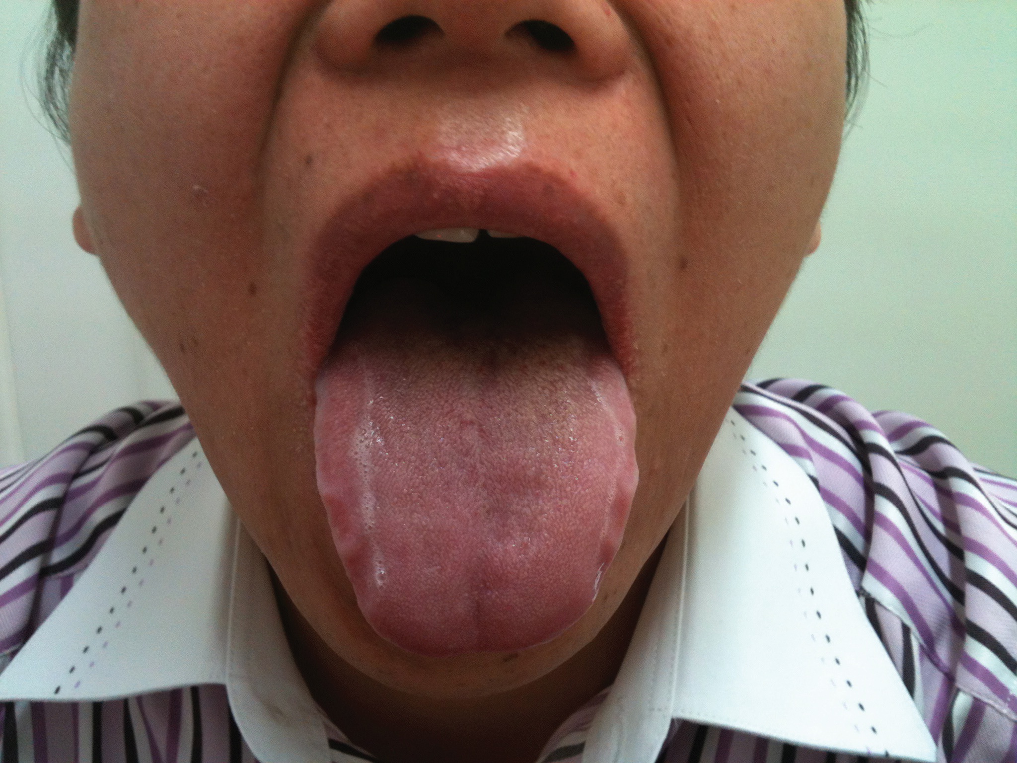 The tongue's deviation on protrusion on the 10th day of
					treatment.The left-sided deviation of the tongue was
					improved 100% on the 10th day of treatment. Treatment
					was terminated.