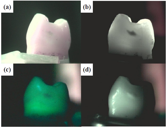 Tooth image of No. 11 (a) incandescent image, (b) DIFOTI image, (c) QLF image, and (d) forward IR image.