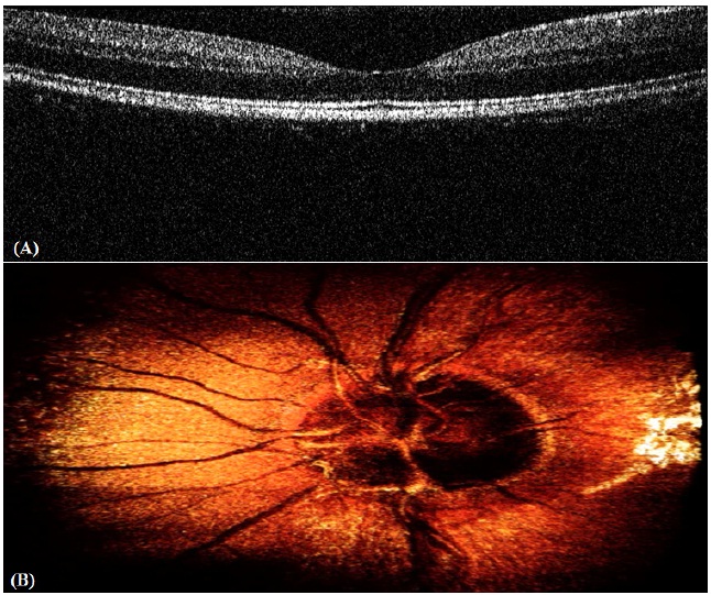 Real-time display OCT image of a human eye. (a) Human retina real-time display 2D movie. (b) Reconstruction of human optic disk 3D image.