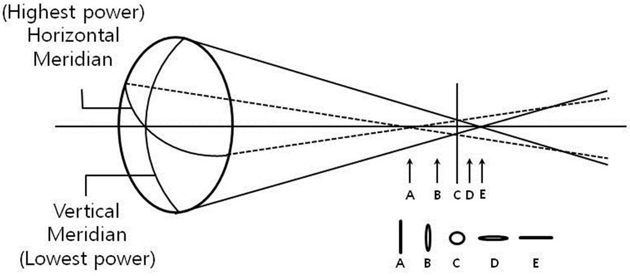 Formation of images within the interval of Sturm of astigmatic eye: anterior focal line (A), posterior focal line (E), circle of least confusion (C), and oval shape between focal line and circle of least confusion (B, D). Maximum visual acuity is detected when circle of least confusion is located at the outer limiting membrane of retina. Uncorrected astigmatism is a cylindrical diopters for distance between two focal lines.