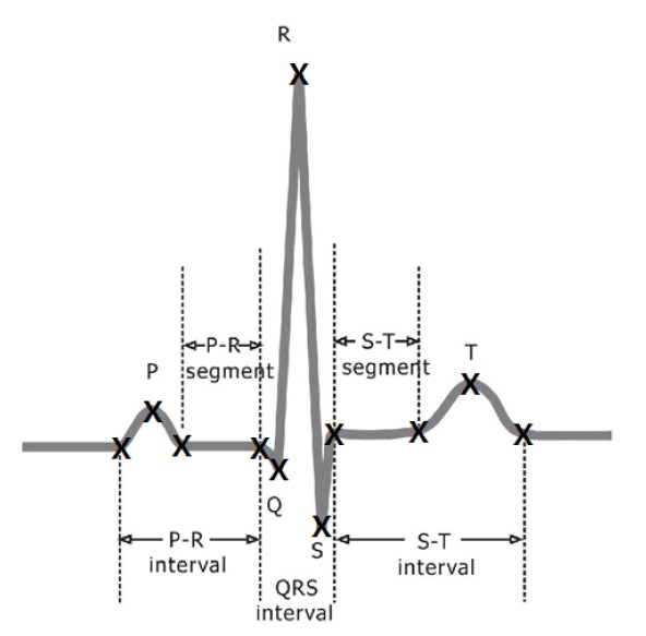Typical electrocardiogramsignal. X, extraction of dominant points.