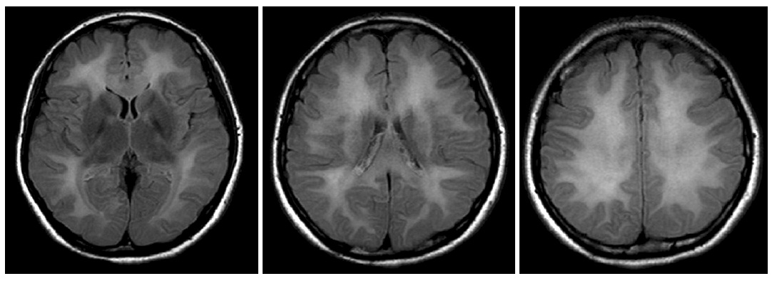 Brain MRI T2-weighted images show increased signal intensity.