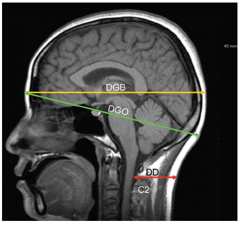 Magnetic resonance imaging parameters for the brain: C2 = the second cervical vertebra; DGO = distance from the glabella to the occipital protuberance; DGB = distance from the glabella to the back of the head; DD = dangerous depth.