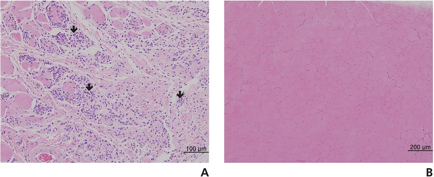 Thigh muscle tissue obtained from 4-week recovery test of Sweet Bee Venom after a 13-week, repeated, intramuscular dose toxicity test
in Sprague-Dawley rats. (A) In the treatment group (0.28 mg/kg every day for 13 weeks), degeneration, fibrosis, inflammation, panniculitis, and necrosis of muscle fiber
were observed. These changes were shown to be severe, depending on the dose. (B) These results show that Sweet Bee Venom has influenced the
muscle fiber, but these changes disappeared during 4-week recovery period. Pathological changes were detected by hematoxylin & eosin (H&E)
staining (× 100 [B], ×200 [A]). In (A) the stars show degeneration of muscle fiber, the small arrow shows regeneration of muscle fiber, the three big
arrows show inflammatory cell infiltration, and the cross shows fibrosis.
