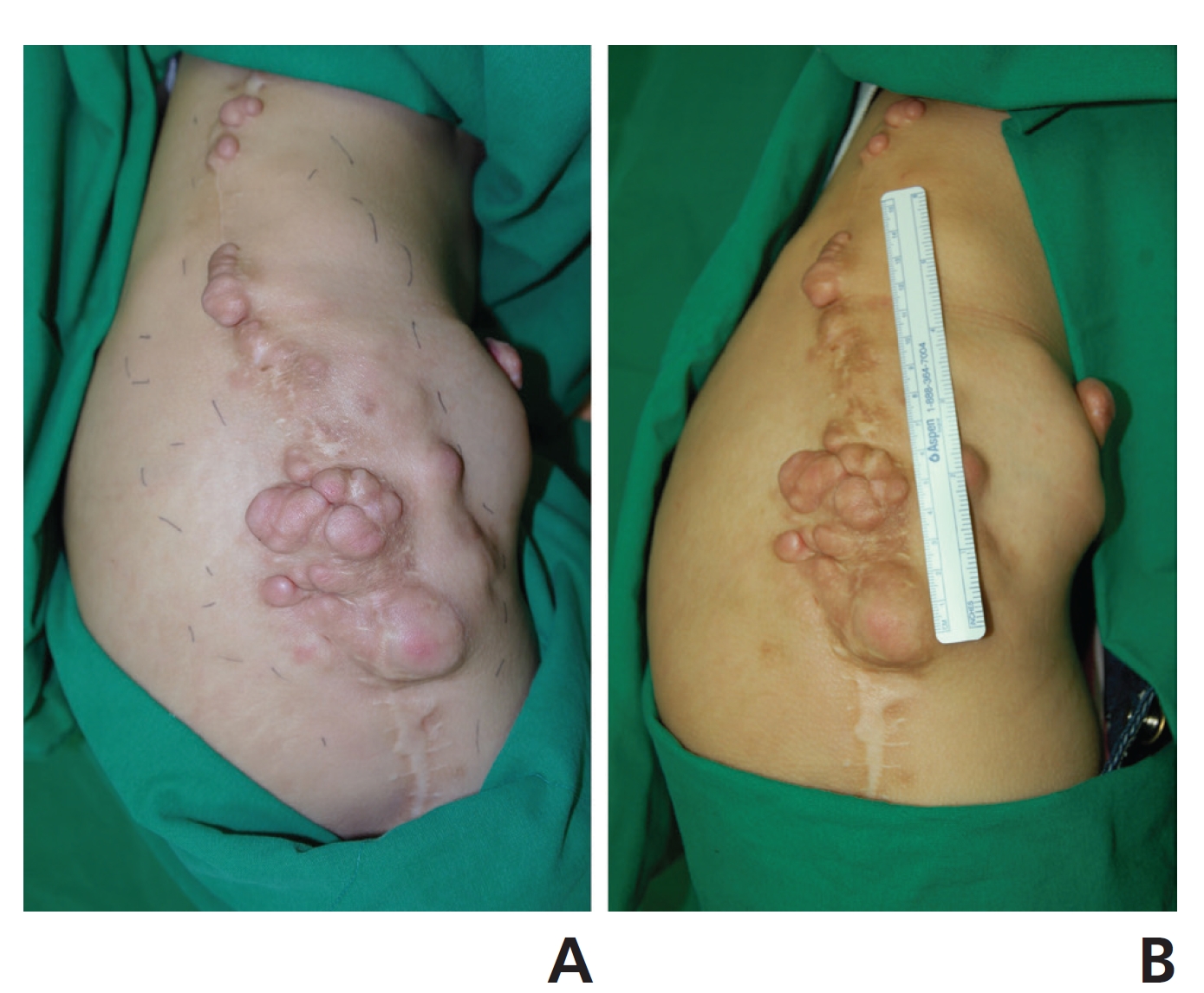 Plexiform neurofibromas in the right pelvic region: (A) photo
in April 2012 and (B) photo in December 2013.