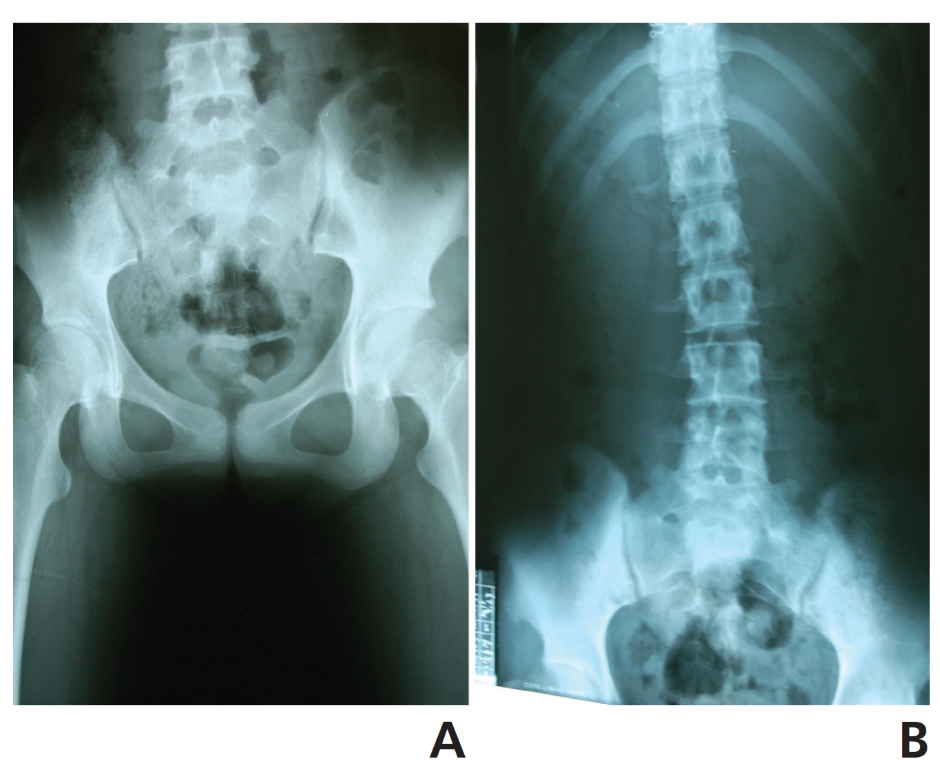 X-rays image taken in March 2013: (A) normal both hip joint
and (B) lumbar spine with mild scoliosis.
