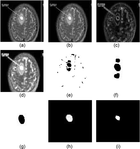 Images at different stages of the proposed method: (a) original image, (b) filtered image, (c) morphological gradient image, (d) enhanced Image, (e) binarized image of I1 obtained using Eq. (9), (f) output image obtained using Eq. (14), (g) image obtained after the execution of the flood-fill algorithm, (h) tumor extracted using the proposed method, and (i) tumor extracted using the method proposed by [20].