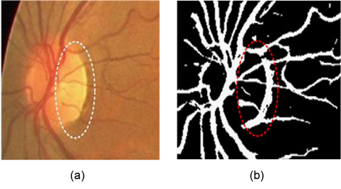 False vessel detection around the optic disk in Nguyen et al. [4]'s multiscale line detector: (a) original image and (b) segmented image. Adapted from Nguyen et al. [4] with permission.