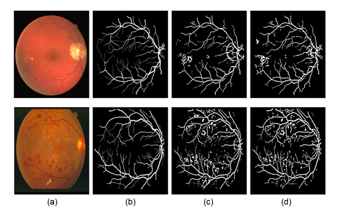 Segmentation results of pathological retinal image: (a) original image, (b) ground truth image, (c) Nguyen et al.’s method, and (d) our method.