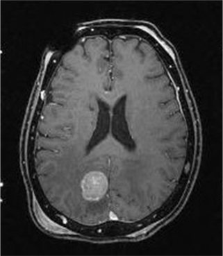 Brain tumor image in MR.