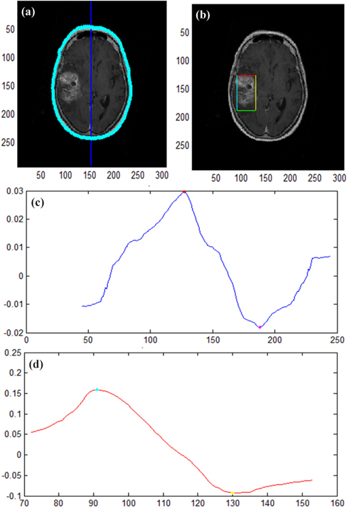 Result of disease detection at the MR image; (a) skull detection and regulation in the original image, (b) disease detection in the MR image, (c) intensity change graph regarding longitudinal section, and (d) intensity change graph regarding transverse section.