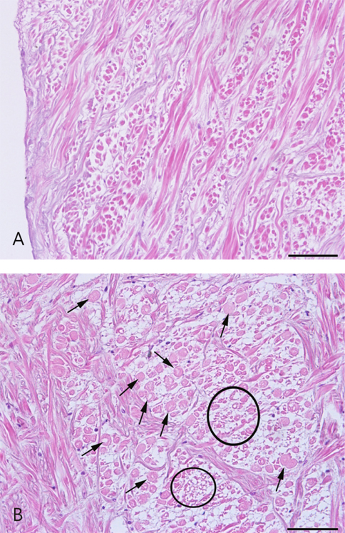 Histological observation of Adductor muscle from clinically healthy cultured abalone Haliotis discus hannai. A: Regular diameter of adductor muscle fibril. B: Cellular swelling in adductor muscle fibril (arrows), More extended degenerative muscle fibrils than normal ones. Cellular atrophy in adductor muscle fibril (elliptical circles). More condensed degenerative muscle fibril than normal ones is associated with myonecrosis. H&E, Bar = 50 μm.