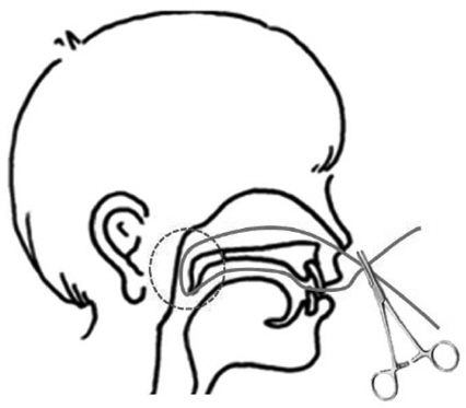 넬라톤 카테터를 사용하여 구개인두부전증을 모의한 그림 [2]