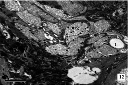 Neurosecretory granules in the in the axonal endings of medial neurosecretory pathways inside the brain of fifth instar larva of A. mylitta . Neurosecretory granules (NSG), Trachiole (T).