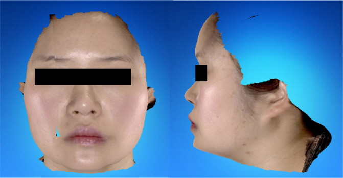 Anterior view and lateral view of face scanned by 3D Facial Scanner (RFS-S100) (APR-3-2014)