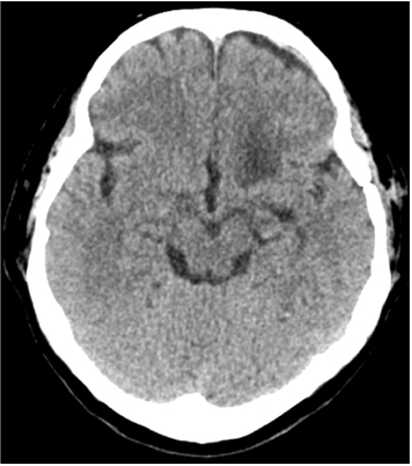 Brain CT (2012.06.12).