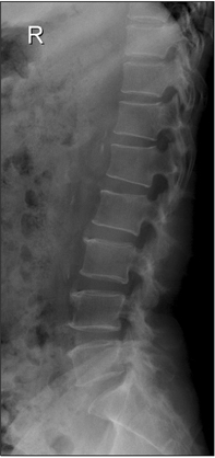 L-spine X-ray (2012.06.12).