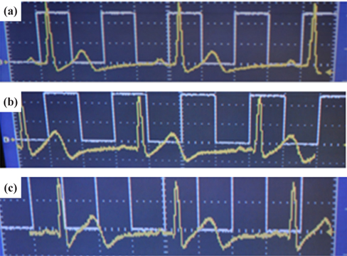 (a) Normal ECG from the ECG simulator, (b) dry contact ECG recording on 24 year old subject’s chest, and (c) non-contact ECG on the subject’s chest through cotton pockets.
