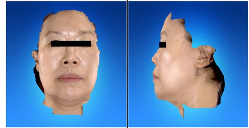 Anterior view and lateral view of face scanned by 3D facial scanner (RFS-S100) (September.-11-2014)