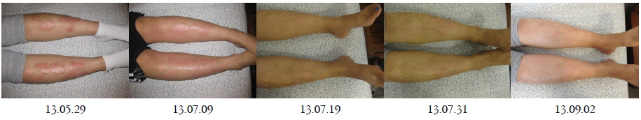 Pictures of psoriasis on lower limbs.